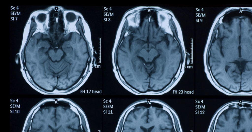Houston Brain Injury Lawyer | Traumatic Brain Injury Lawyer | TBI Injury Lawyer