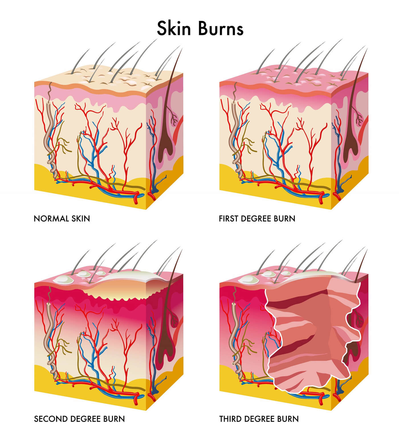 Houston Burn Injury Lawyer - Texas Burn Injury Lawyer - Zehl & Associates