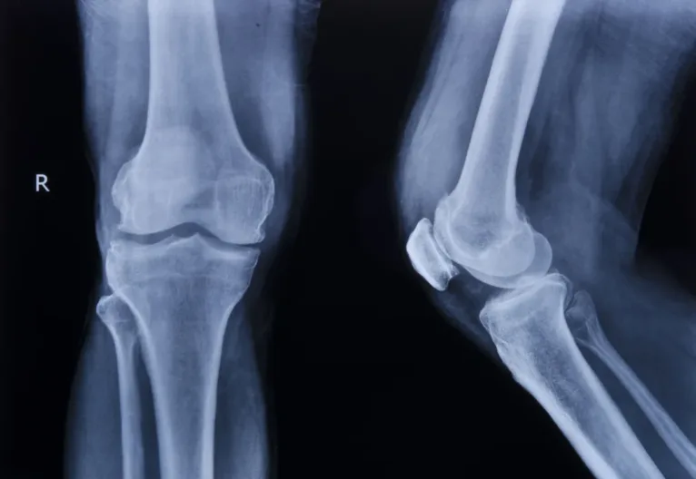 Knee Injury