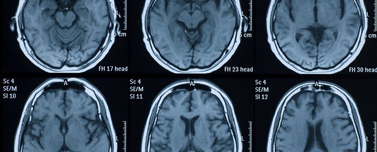 Traumatic Brain Injuries